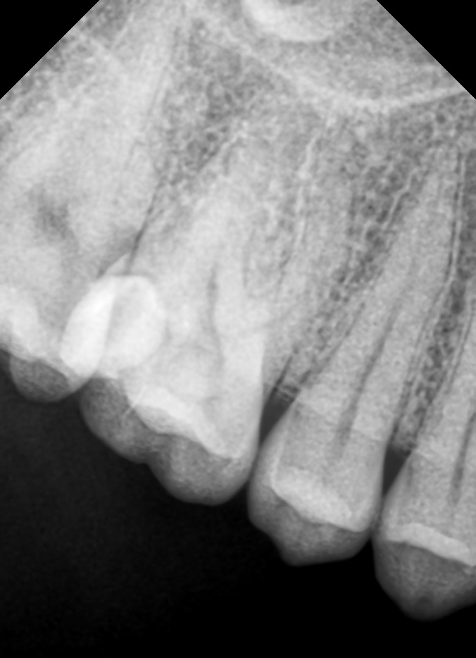 Endodoncia