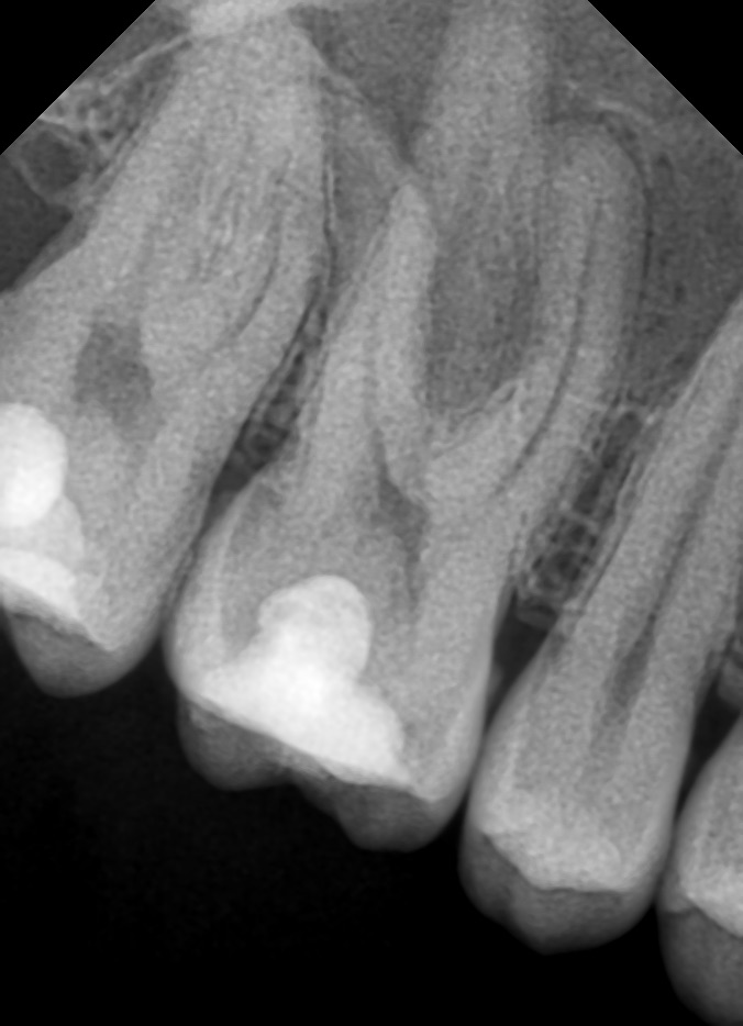 Endodoncia