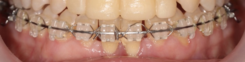 Brackets Estéticos