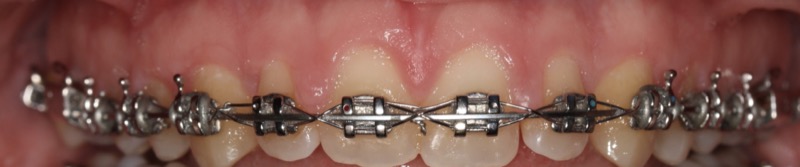 Brackets